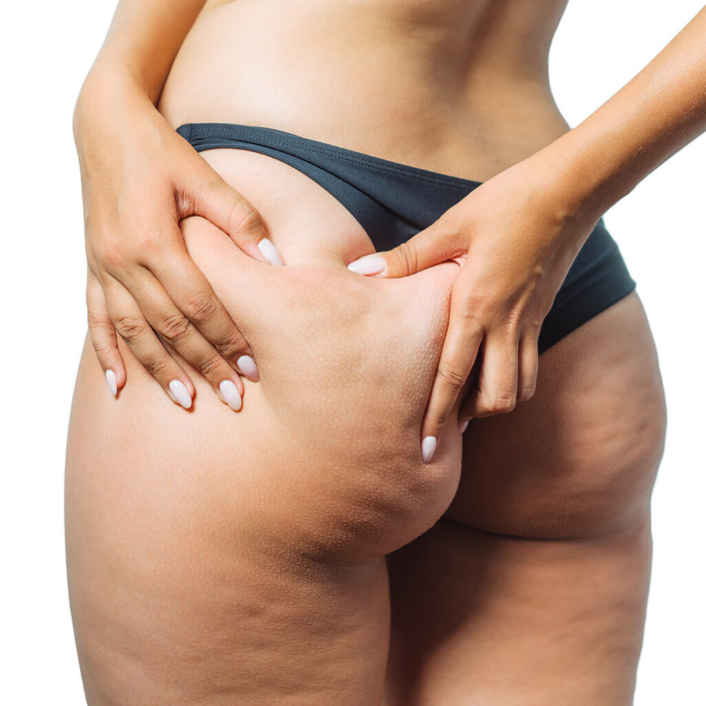 eliminacion-de-celulitis