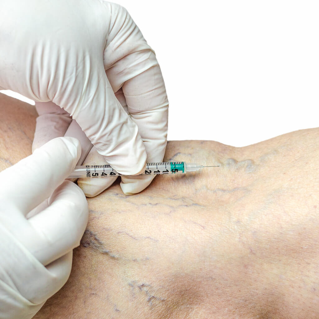 escleroterapia